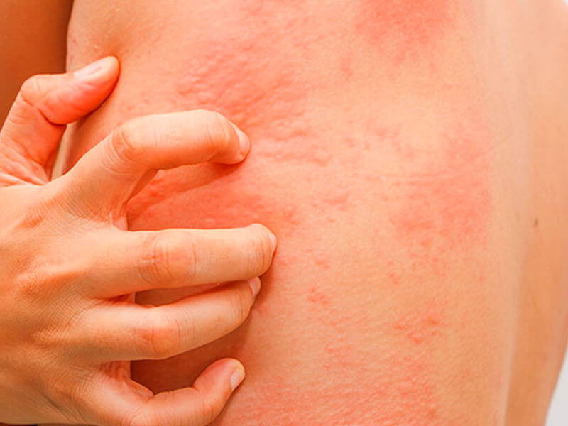 Хроническая крапивница и почему таблетки помогают не всегда